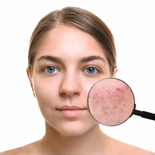 Логотип @acneblogg - АКНЕБЛОГ