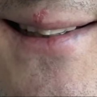 Логотип @gerpesstasa - Герпес Стаса Ярушина