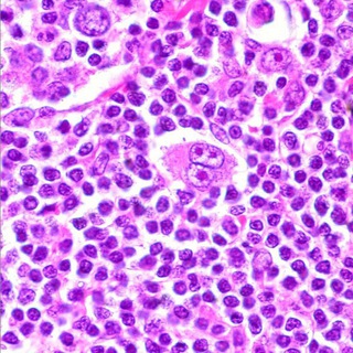Логотип @hodgkinslymphoma - Лимфома Ходжкина