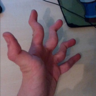 Логотип @rakurilshika - Ревматоидный артрит курильщика